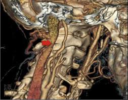 Similarly, dissections affect distal parts of the extracranial vertebral artery, whereas atherosclerosis tends to involve the proximal segments Scielo Brasil Internal Carotid Artery Dissection After Laparoscopic Surgery Internal Carotid Artery Dissection After Laparoscopic Surgery