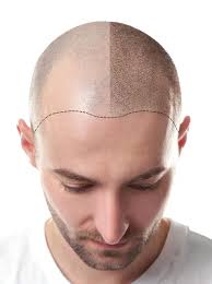 Saç Ekimi İle Saçlarınızın Yeniden Uzaması İçin Rehber