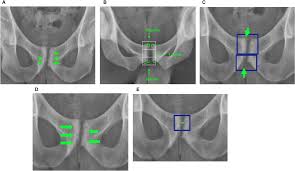 Image result for Pubic Apophysitis