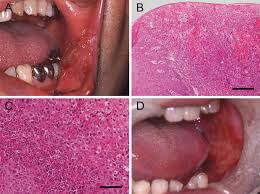 Image result for spinocellular carcinoma of the oral cavity