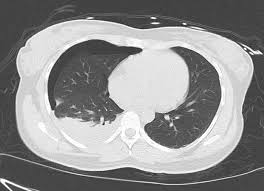 Thoracic endometriosis is characterized mainly by clinical presentations such as; Refractory Thoracic Endometriosis Bmj Case Reports