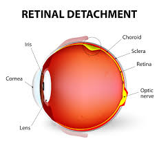 It's a big day for today's savannah guthrie! Retinal Detachment