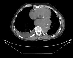 The journal of thoracic disease indicates that not only does mesothelioma show up on a ct scan, but it is the preferred diagnostic tool of choice for advanced stage mesothelioma cases. Malignant Pleural Mesothelioma Presenting With A Giant Posterior Mediastinal Mass Consultant360