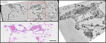 Respiratory | trachea, bronchioles and bronchi. 3d Virtual Pathohistology Of Lung Tissue From Covid 19 Patients Based On Phase Contrast X Ray Tomography Elife