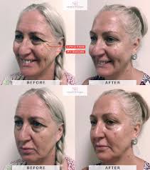 Cosmetic Injectables by Samantha Baker