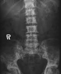 Although prostate cancer cells produce numerous osteogenic factors, to date, none have been shown to … Osteoblastic Metastasis From Prostatic Cancer Plain Radiograph Showing Download Scientific Diagram