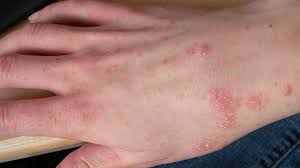 Image result for scabies on humans
