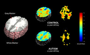 Many of the institutes at the nih, including the ninds, are sponsoring research to one study is using functional magnetic resonance imaging (fmri) to show how abnormalities in particular areas of the brain cause changes. Big Data In Human Neuroimaging Ucsd Neurosciences
