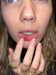 What is worse, the ear lobe or the lips?