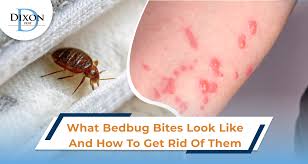 Image result for Cimex lectularius bites