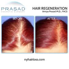 However if hair loss is caused by hormonal imbalances, finding a cure is more difficult. Why Acell Prp Treatments Are Not All The Same Hair Regeneration