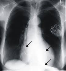 The roentgen or röntgen (/ˈrɜːntɡən/; Schrittmacher Gegen Herzschwache Crt