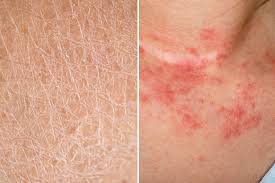 Image result for Dry Skin