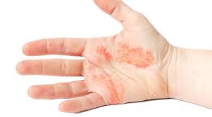 Image result for Hand Dermatitis