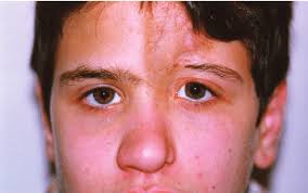 A 14-year-old boy with linear scleroderma en coup de sabre. Skin...