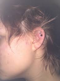 I Got My Cartilage Pierced Double Piercing About 5 Days Ago It Bruised Now It S Swollen Red Sore And Hot To Touch Photo