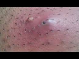 Though ingrown hair is often infected it is recommended to visit the doctor if there is recurrent ingrown hair. Huge Ingrown Hair From Shaving Pubic Area Headphone Users Beware Youtube