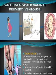 Image result for Vacuum Caput