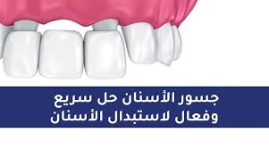 جسور الأسنان أفضل الأنواع والأسعار وكم مدة البقاء تركي ويز