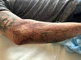 Tattoo bandages are a simple part of the tattoo healing process that can be confusing for inexperienced ink enthusiasts, or those looking to use a wait a minimum of 2 to 3 hours before taking off your initial bandage. 10 Things You Should Know About Laser Tattoo Removal Lead The Followers