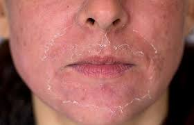 Check spelling or type a new query. How To Do A Chemical Peel At Home What You Need To Know