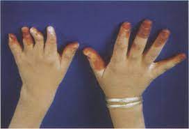 Poland's syndrome is a rare congenital disorder characterized by unilateral chest wall hypoplasia, ipsilateral hand abnormalities, and a variety of associated anomalies. Http Www Jprasurg Com Article S0007 1226 00 93505 7 Pdf