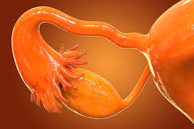 Where do they come from? Most Or All Ovarian Cancer Originates In The Fallopian Tubes
