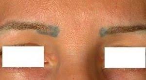 The tattoo removal process is a specialised skill which takes much care and attention. Guidelines For Permanent Makeup Removal Eyebrow Laser Tattoo Removal