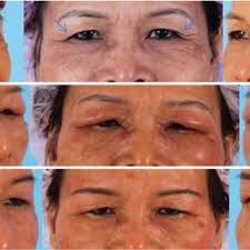 Read about outbreaks of botulism poisoning, causes (clostridium botulinum toxin), symptoms (muscle paralysis, dry mouth, constipation), history, treatment, and types (foodborne, infant, wound). Pdf Nonallergic Eyelid Edema After Botulinum Toxin Type A Injection