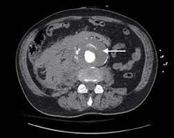 Please log in to renew your membership, and enjoy another year of aaa. Ruptured Aaa Presenting With Unresponsiveness And Cardiac Arrest Jetem