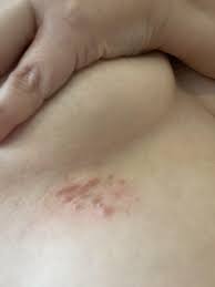 Image result for heat rash under breasts