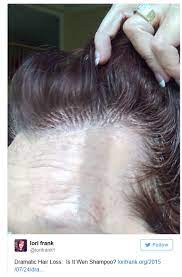Thu, december 17, 2015 at 9:00 am. Wen Hair Products Prompt Law Suit From Women With Hair Loss