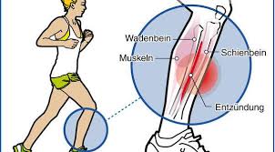 Itbs (it band pain) is the most prevalent cause of lateral (outside) knee pain in athletes. Wenn Das Schienbein Plotzlich Schmerzt