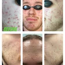 THE BEST 10 ACNE TREATMENT in ST. AUGUSTINE, FL