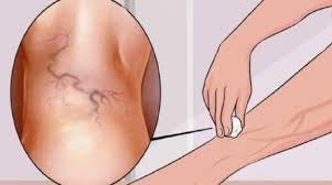 Alle Haben Dieses Wundermittel Gegen Krampfadern Im Haus Stehen Aber Niemand Weiss Davon Mit Bildern Krampfadern Gesundheit Hausmittel