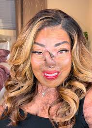 It's never too late to change your life. Monday, this forehead flap becomes  a nose and I'm living the life I always wanted to live.🦋