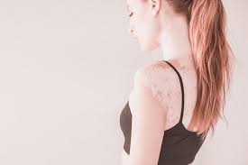 Image result for robert zaruba vitiligo