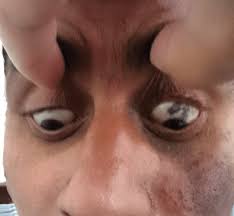 Image result for melanosis sclera