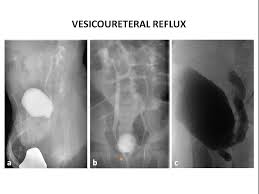 Vesicoureteral reflux is the retrograde flow of urine from the bladder to the kidneys. Epos Trade
