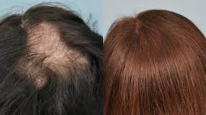 Eucalyptus essential oil can also be used to enhance hair growth by improving blood circulation in the scalp. How To Stop Hair Fall Thinning At Home Hair Growth Superprincessjo Youtube