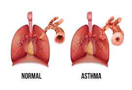 Refill prescriptions online, order items for delivery or store pickup, and create photo gifts. Cannabis And Asthma Top 5 Benefits Do S And Don Ts Sensi Seeds