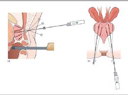 Improving the safety and tolerability of local anaesthetic outpatient  transperineal prostate biopsies: A pilot study of the CAMbridge PROstate  Biopsy (CAMPROBE) method