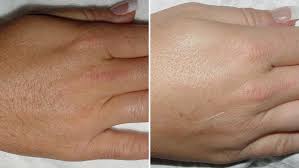 They include temporary or permanent patches of light or dark skin, burns, excessive redness and swelling around your hair. Coolglide Laser Hair Removal Lakes Dermatology