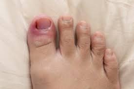 It's widely available, inexpensive, and can quickly kill the fungus. Ouch How To Fix Ingrown Toenails Now My Footdr