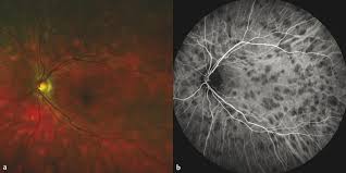 Birdshot Retinochoroiditis Ento Key