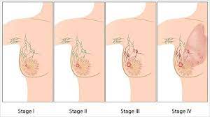 Stage 4 breast cancer may develop these symptoms especially if the tumor is large or involves the breast skin. The Stages Of Breast Cancer What You Need To Know Everyday Health