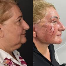 What a difference a day makes!! Here is my lovely 65 year old patient less  than 24 hours after her #deepplanefacelift #platysmaplasty and #co2laser  done yesterday! I also performed a #buccalfatremoval to