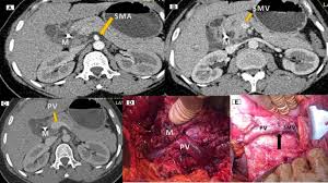 In one study, the sensitivity was 100 percent for tumors >2 cm, but only 77 percent for tumors ≤2 cm in size 30. Preoperative Ct Staging Of Borderline Pancreatic Cancer Patients After Neoadjuvant Treatment Accuracy In The Prediction Of Vascular Invasion And Resectability Springerlink