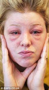 Holidaygoer Has Eyes Glued Shut After Severe Allergic Reaction To Eyelash Tinting Treatment Daily Mail Online
