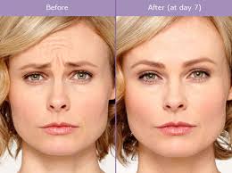 Angela deem has always been open about her cosmetic treatments. Have You Considered Botox Treatments Aesthetica
